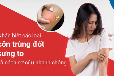 Nhận biết các loại côn trùng đốt sưng to và cách sơ cứu nhanh chóng