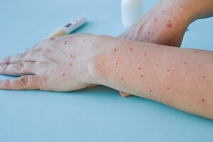 Bộ Y tế xếp đậu mùa khỉ vào bệnh truyền nhiễm nhóm B