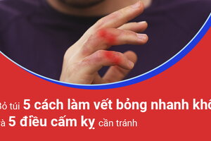 Bỏ túi 5 cách làm vết bỏng nhanh khô và 5 điều cấm kỵ cần tránh