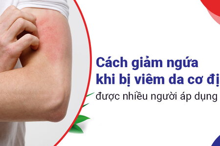 Cách giảm ngứa khi bị viêm da cơ địa được nhiều người áp dụng