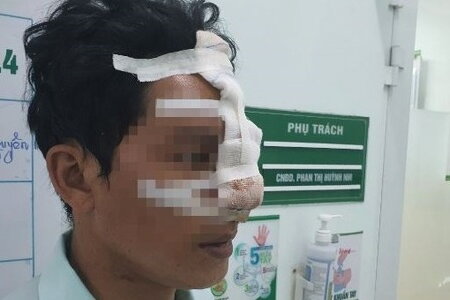 Bình Phước: Người đàn ông 33 tuổi bị bạn cắn đứt mũi vì can đánh nhau trên bàn nhậu