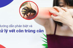 Hướng dẫn phân biệt và xử lý vết côn trùng cắn