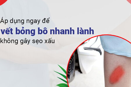 Áp dụng ngay để vết bỏng bô nhanh lành, không gây sẹo xấu