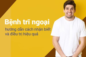 Bệnh trĩ ngoại: hướng dẫn cách nhận biết và điều trị hiệu quả