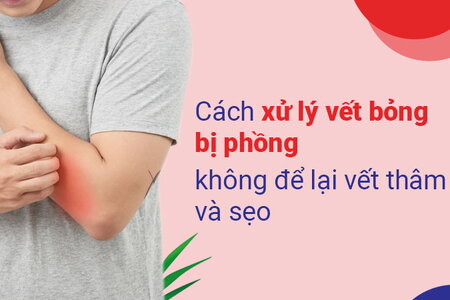 Cách xử lý vết bỏng bị phồng, không để lại vết thâm và sẹo