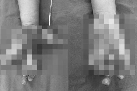 Hà Nội: Thiếu niên 14 tuổi bị nát tay do điện thoại bất ngờ phát nổ