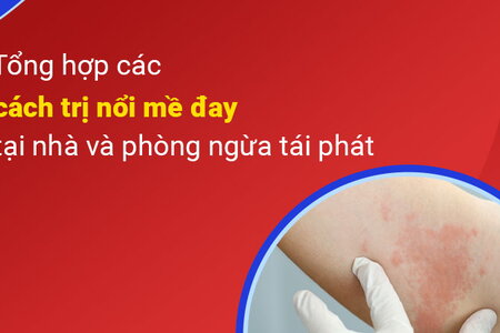 Tổng hợp các cách trị nổi mề đay tại nhà và phòng ngừa tái phát