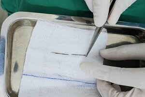Bác sĩ kịp thời gắp kim may quần áo đi lạc nằm sâu trong phổi bé 4 tuổi