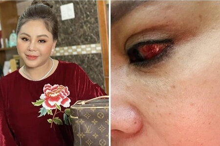 Nghệ sĩ Lê Giang rách giác mạc nặng, mắt tụ máu bầm do tai nạn