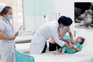 Lấy búi tóc to ra khỏi dạ dày bé gái 3 tuổi mắc hội chứng ăn tóc