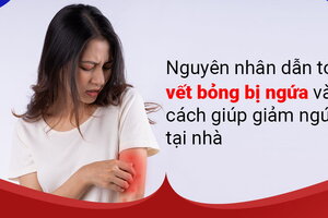 Nguyên nhân dẫn tới vết bỏng bị ngứa và cách giúp giảm ngứa tại nhà