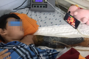 Vào công trình xây dựng chơi, bé trai 7 tuổi bị máy trộn bê tông cuốn nát tay