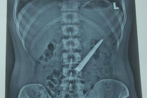 Cứu sống thanh niên 27 tuổi nuốt lưỡi dao dài hơn 10cm vào bụng