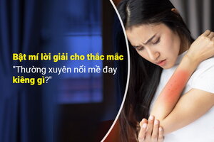 Bật mí lời giải cho thắc mắc “Thường xuyên nổi mề đay kiêng gì?”