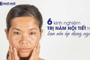 6 kinh nghiệm trị nám nội tiết hay bạn nên áp dụng ngay