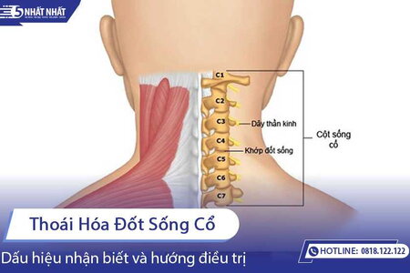 Thoái hóa đốt sống cổ: Dấu hiệu nhận biết và hướng điều trị