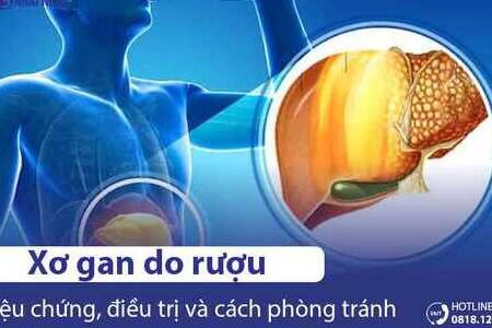 Xơ gan do rượu là bệnh gì? Nguyên nhân, Triệu chứng & Cách điều trị