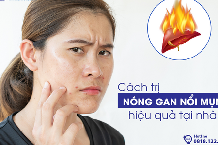 Cách trị nóng gan nổi mụn hiệu quả tại nhà