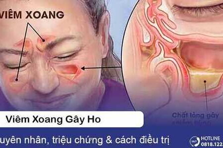 Viêm xoang gây ho: Nguyên nhân, triệu chứng & cách điều trị