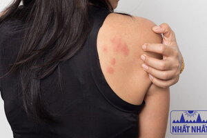 Bật mí các phương pháp điều trị mề đay mãn tính hiệu quả
