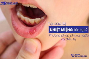 Tại sao bị nhiệt miệng liên tục? Phương pháp phòng ngừa và điều trị hiệu quả