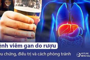 Viêm gan do rượu: Nguyên nhân, Biểu hiện, Triệu chứng và Cách điều trị
