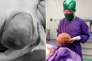 Bóc tách thành công khối u vú trái kích thước “khủng” nặng hơn 3kg cho phụ nữ 50 tuổi