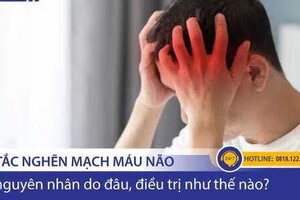 Tắc nghẽn mạch máu não có nguyên nhân từ đâu? Điều trị như thế nào?