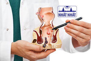 Những điều cần biết về bệnh trĩ và cách điều trị tại nhà