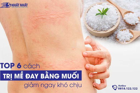 TOP 6 cách trị mề đay bằng muối giảm ngay khó chịu