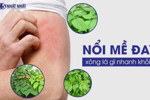 Nổi mề đay xông lá gì nhanh khỏi?