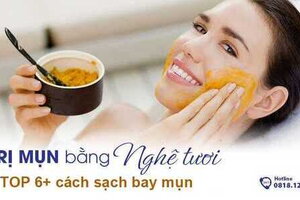 TOP 6+ cách trị mụn bằng nghệ tươi sạch bay mụn