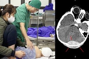 Ngã đập đầu xuống sàn nhà, bé 11 tháng tuổi bị nứt xương sọ, tụ máu não