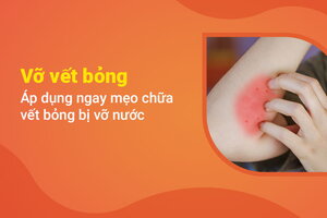 Vỡ vết bỏng - Áp dụng ngay mẹo chữa vết bỏng bị vỡ nước