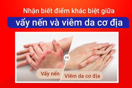 Nhận biết điểm khác biệt giữa vẩy nến và viêm da cơ địa