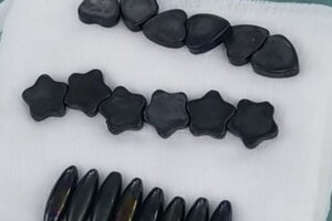 Bé trai 10 tuổi phải cắt bỏ 15 cm ruột non do nuốt phải nam châm