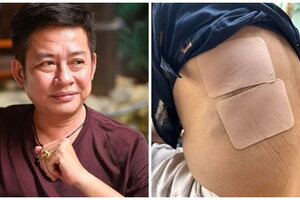Nghệ sĩ hài Tấn Beo bất tỉnh sau cú ngã cầu thang, lưng và hông bị chấn thương nặng