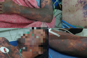 Hai người đàn ông nguy kịch do ăn tiết canh ngan và thịt lợn ốm