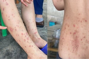 Hà Tĩnh: Hàng trăm người dân bị nổi sẩn khắp cơ thể do bọ chét cắn