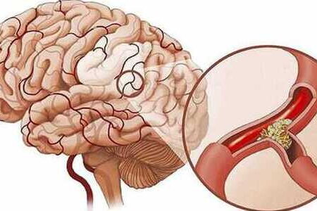 Một số bài thuốc điều trị thiếu máu não hiệu quả