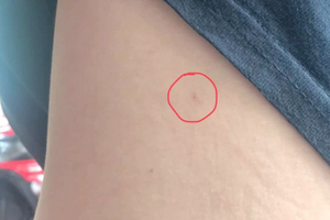 Xác minh thông tin người dân bị chích kim tiêm khi đi dạo trong khu đô thị Sala