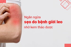 Ngăn ngừa sẹo do bệnh giời leo nhờ kem thảo dược