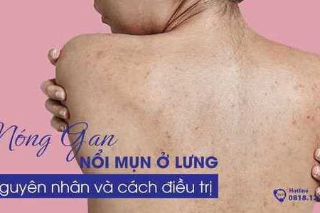 Nóng gan nổi mụn ở lưng: Nguyên nhân và cách điều trị