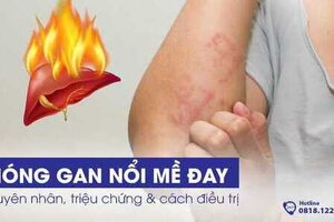 Nóng gan nổi mề đay: Nguyên nhân, triệu chứng & cách điều trị