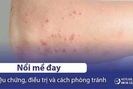 Nổi mề đay: Nguyên nhân, Dấu hiệu, Triệu chứng & Cách điều trị