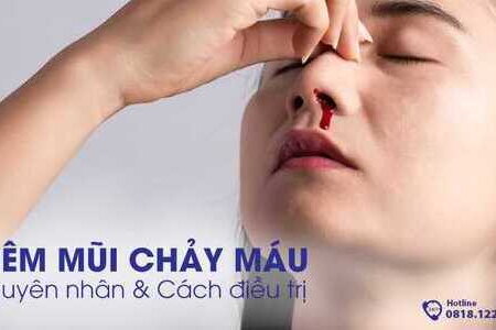 Viêm mũi chảy máu: Nguyên nhân & cách điều trị