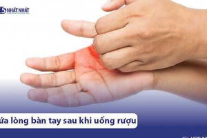 Lý do uống rượu bia bị ngứa lòng bàn tay & Cách khắc phục