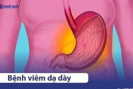 Viêm dạ dày là gì? Nguyên nhân, triệu chứng, cách điều trị