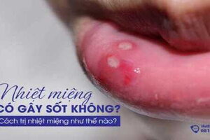 Nhiệt miệng có gây sốt không? Cách trị nhiệt miệng như thế nào?