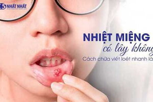 Nhiệt miệng có lây không? Cách chữa vết loét nhanh lành